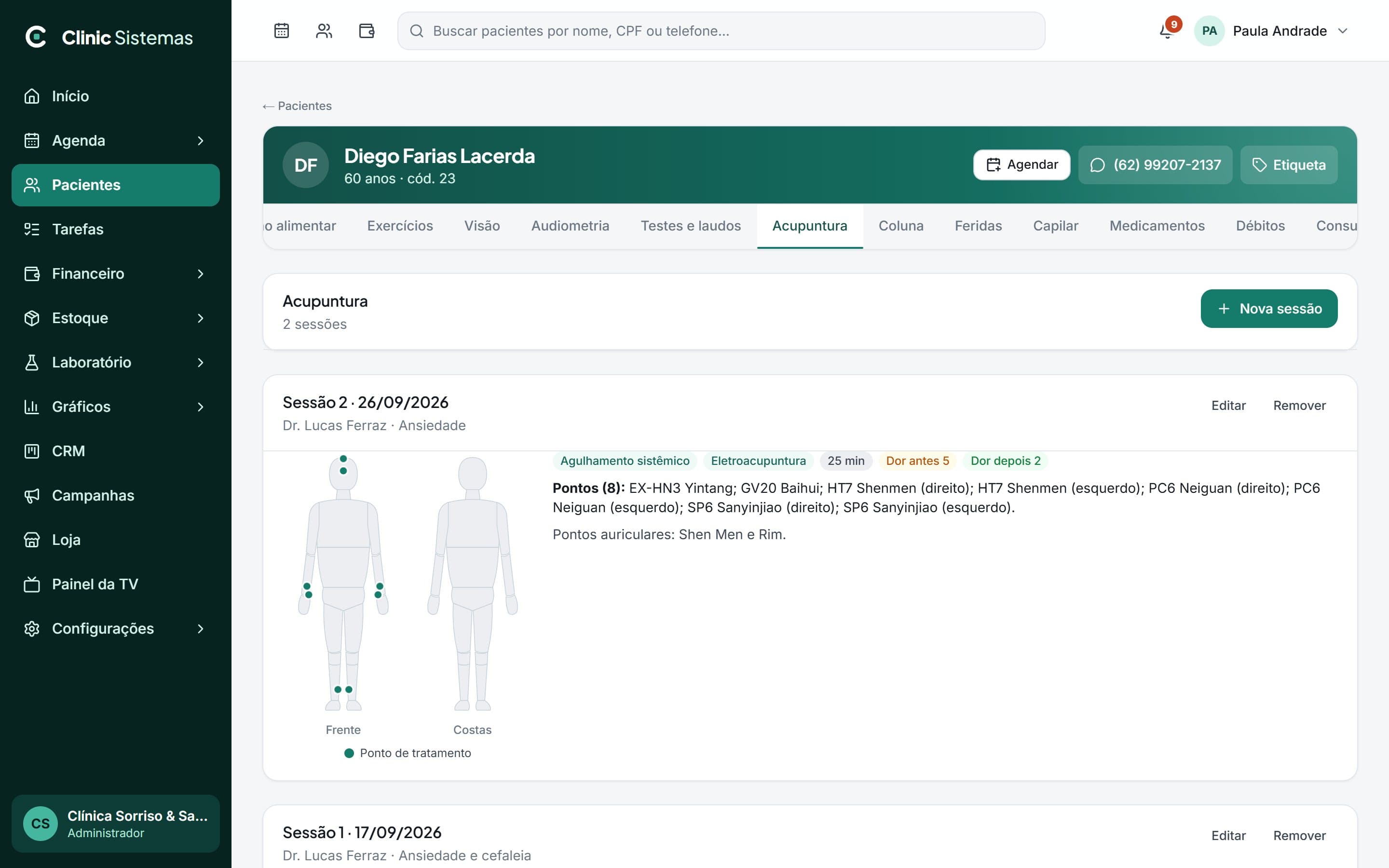 Sessão de acupuntura com pontos marcados no corpo e dor antes e depois